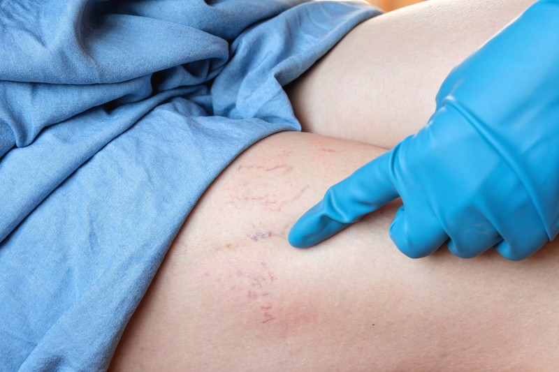 Artériás zavarok: erről ismeri fel az orvos