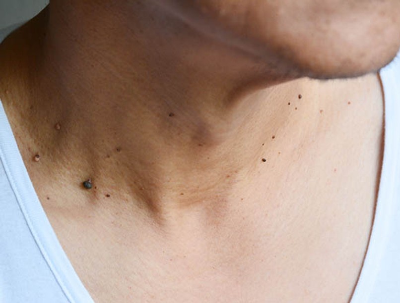 szemölcs, bőrkinövés, bőrprobléma, vírus