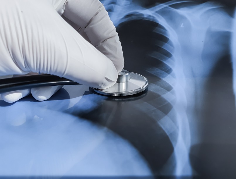 tBC tuberkolózis növekedés Európa