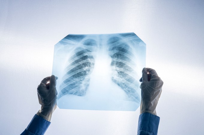 Tüdőrák - ezek a legfontosabb vizsgálatok című cikk nyitóképe