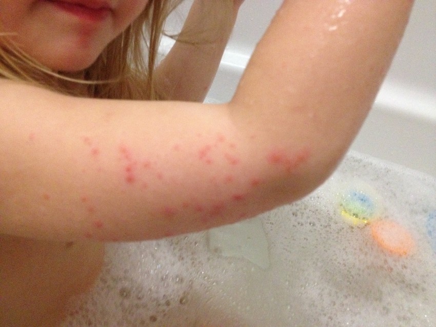 A GCS-bőrtünetek az arcon, a végtagokon szimmetrikusan, a feszítő felszíneken, a hajlítófelszíneket szabadon hagyva, nem viszkető, halvány vagy sötétvörös, esetleg bevérzett jellegű kiütésekként jelennek meg. 