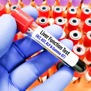 Mit jelent az AST (GOT) érték a laborleleten? című cikk nyitóképe