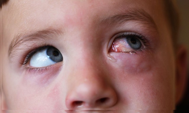 Van olyan szemcsepp, amit vény nélkül lehet kapni kötőhártya-gyulladásra? Az orvos válaszol