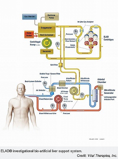 Májdialízis? Mesterséges májjal az alkoholos májelégtelenség ellen