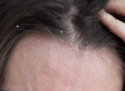 Mi a különbség a zsíros és a száraz korpa között, és mit lehet tenni ellenük? című cikk nyitóképe