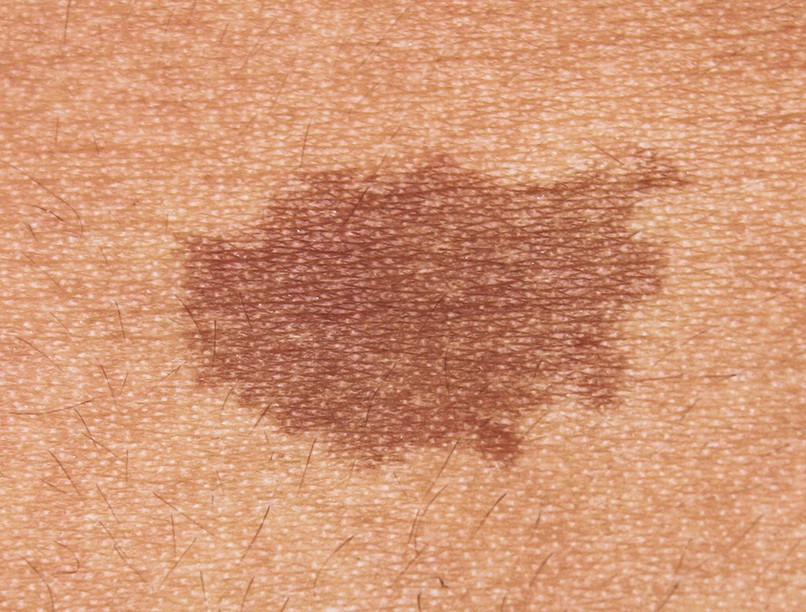 bőrbetegség, bőrgyulladás, bőrelváltozás, daganatos bőrelváltozás, bőrrák