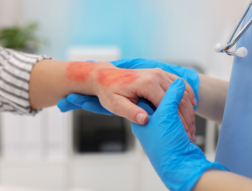 Égés, forrázás tünet vizsgálat kezelés