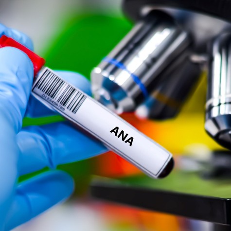 ANA teszt: mit üzen valójában ez a laboreredmény? című cikk nyitóképe