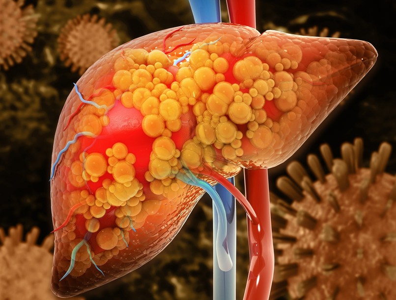 cukorbetegség zsírmáj oka inzulinrezisztencia diabétesz