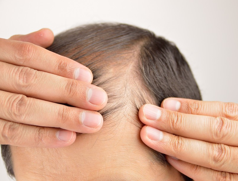 férfi hajhullás ellen