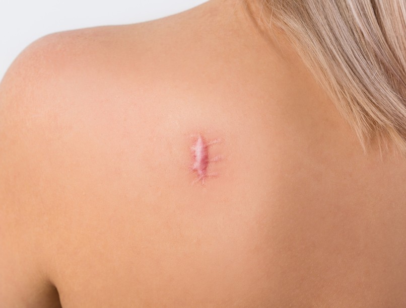 keloid, heg, seb, kezelés