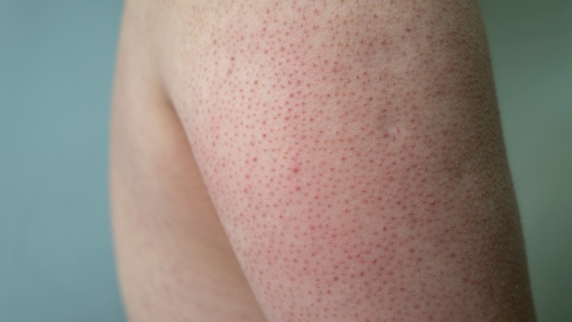 csirkebőr, bőr, gríz, bőrprobléma, keratosis pilaris