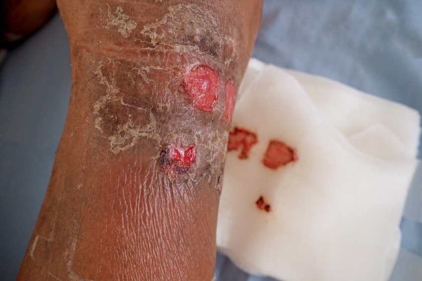 A rezsiztens baktérium okozta fertőzések sokszor elhúzódóak, nehezen kezelhetőek, már csak speciális, drága, erős hatású antibiotikumokra érzékenyek. A fertőzés a véráramba törve szepszist vagy szervi elégtelenséget, akár többszervi elégtelenséget okozó fertőzések kezelése mindig nehezebb. Légzési és szívelégtelenség, veseelégtelenség is felléphet. A fertőzésnek súlyos elesett állapotú betegek esetén magas lehet a halálozása.