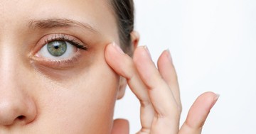  Duzzadt, fáradtnak tűnő szemek: mit tehetünk a szem alatti sötét karikák ellen? 