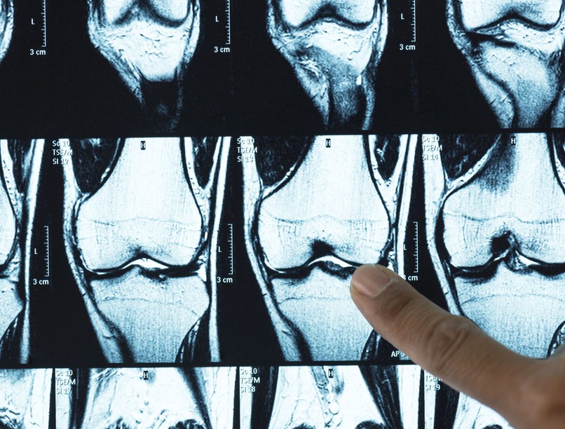 porckopás porcszövet helyreállítás kezelés