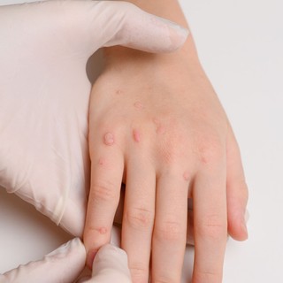 Nem csak esztétikai gond: így kezelhetők biztonságosan a gyermekkori szemölcsök című cikk nyitóképe