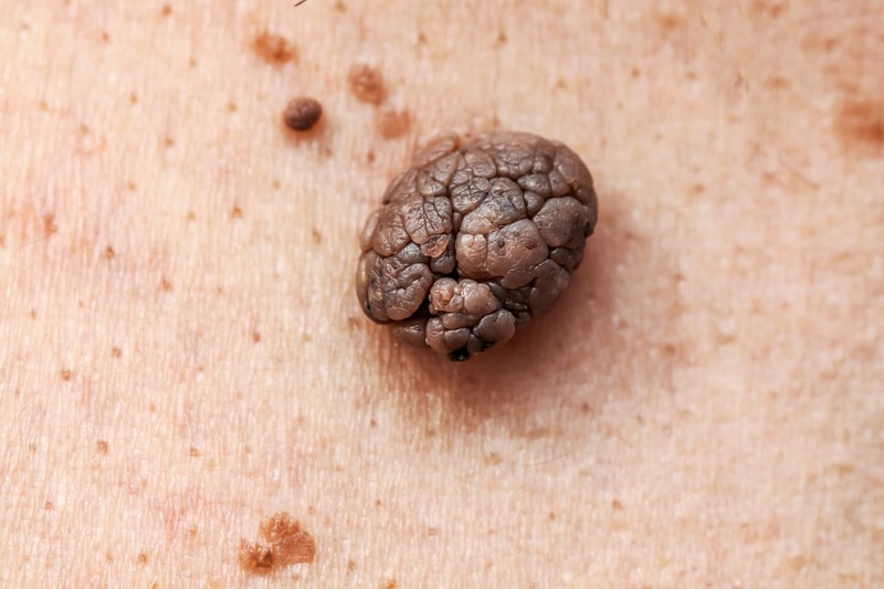 Bőrrák tünetek: ezek az elváltozások lehetnek gyanúsak az anyajegyeken