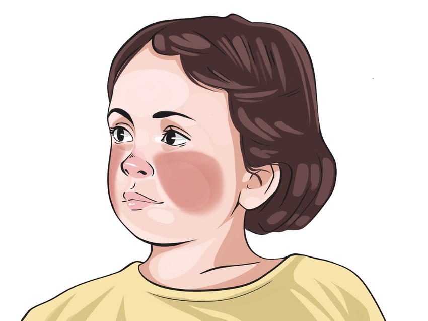 Skarlát-arcpír: a kipirosodás száj körüli sápadtsággal társul.