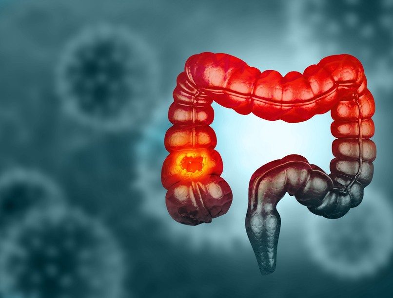 vastagbélrák szűrés vizsgálat halálozási statisztika