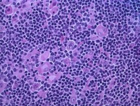 Új eljárásnak köszönhetően rövidül a limfómás betegek kórházi ellátása