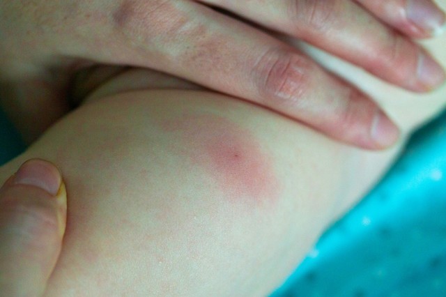 Méhcsípés: ezt tegye, hogy elkerülje a komolyabb bajt!