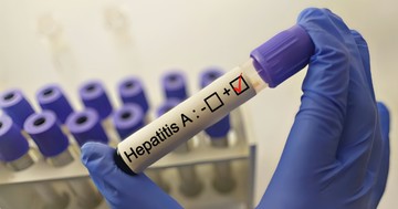 Májgyulladás Hepatitis A vírus fertőzéstől: tünete, vizsgálata és kezelési lehetőségei