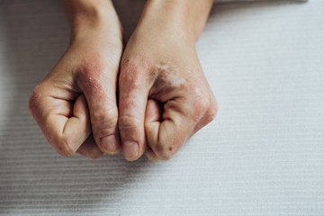 Mitől alakul ki a pikkelysömör?