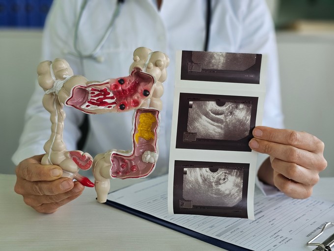 Mikor érdemes kolonoszkópiára menni, ha volt a családban vastagbélrákos? Az orvos válaszol című cikk nyitóképe