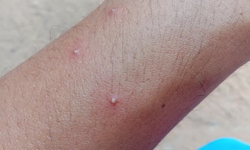 Így néz ki a hangyacsípés