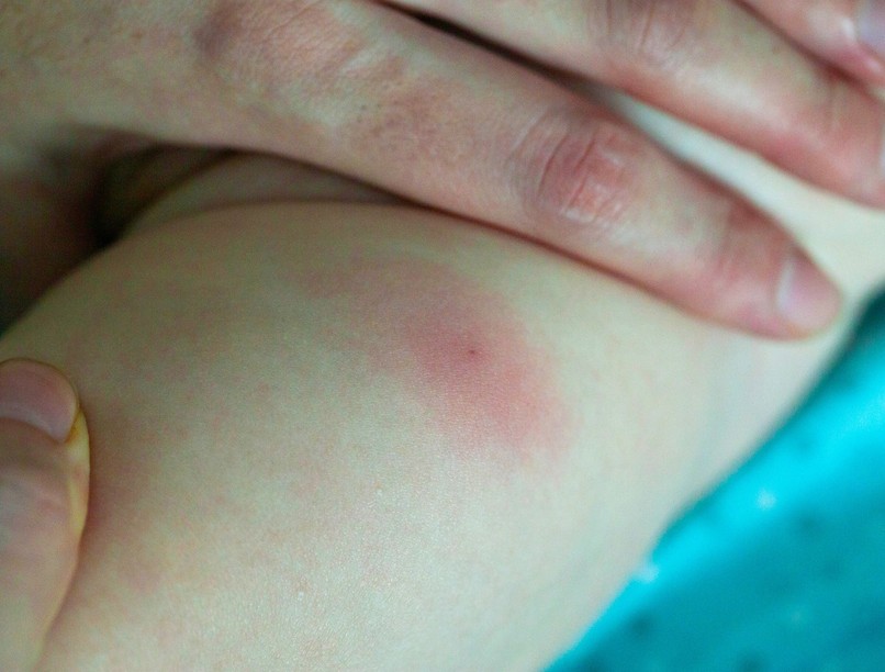 Méhcsípés ellen allergia anafilaxiás sokk