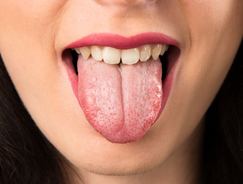 térkép nyelv gyulladás vörös