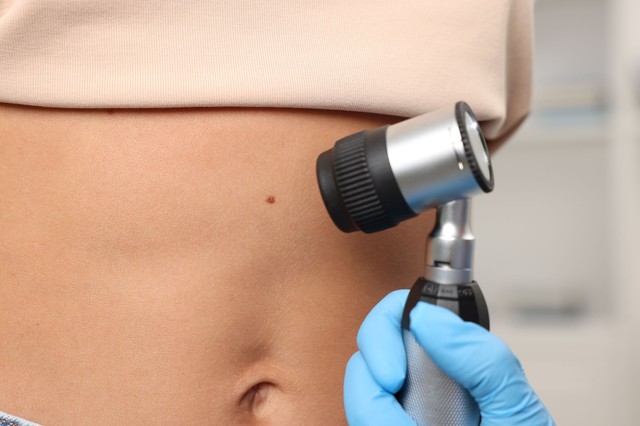 Veszélyes anyajegyek: 5 jel, ami miatt azonnal bőrgyógyászhoz kell fordulni