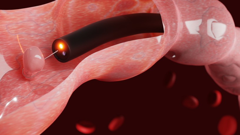 rosszindulatú vastagbéldaganat, szűrővizsgálat, kolonoszkópia, rák, bélrák, diagnosztizálás, bélrendszer, polip