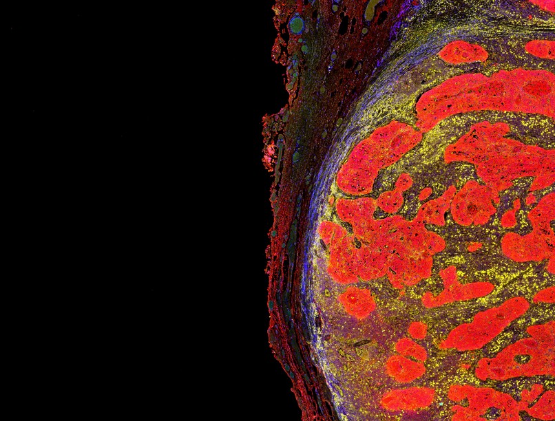 Immunterápiás rákkezelés hatásossága hatása kutatás