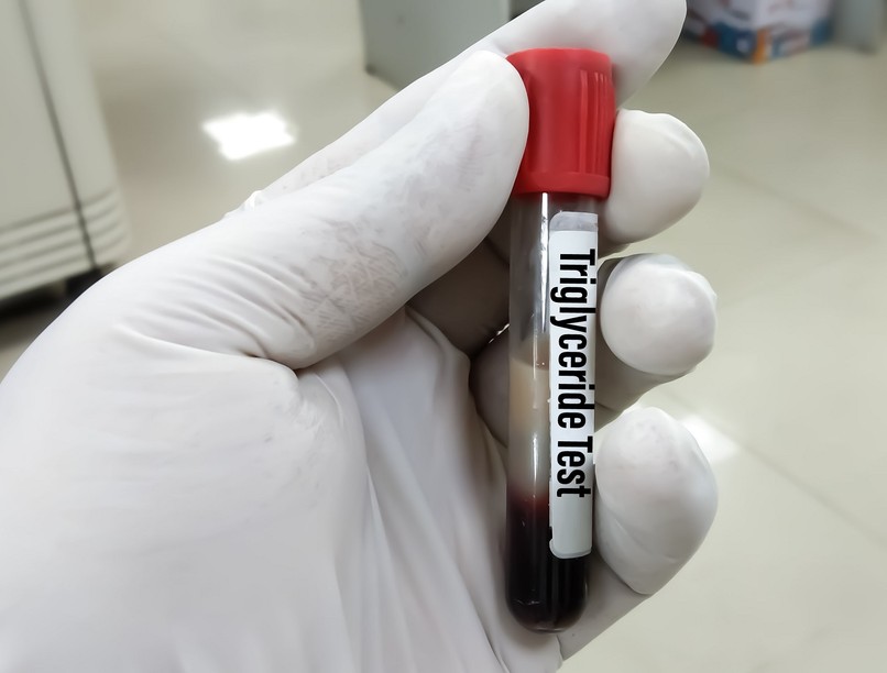 Mit jelent triglicerid érték laborlelet