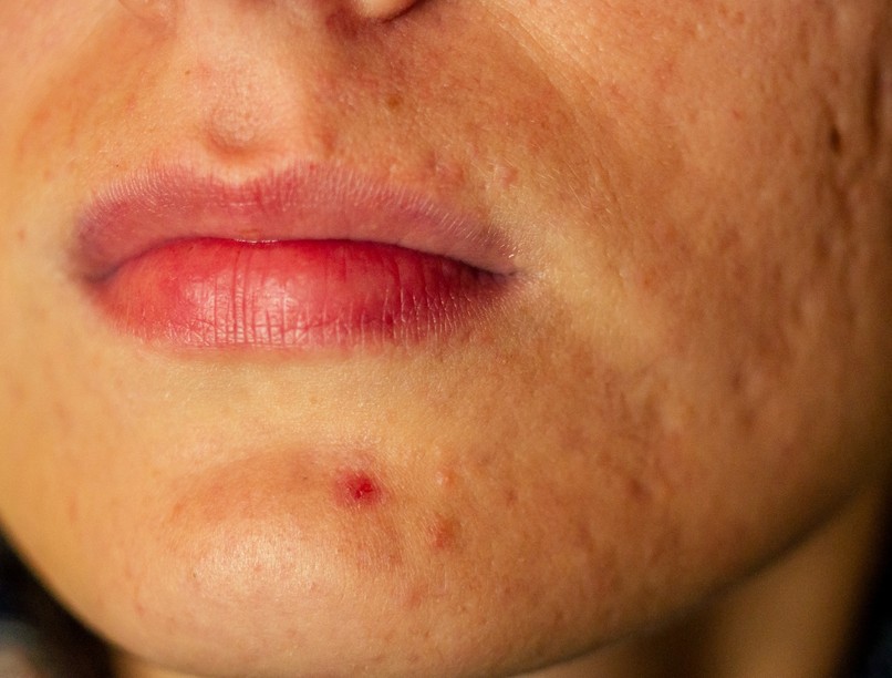 akne, pattanas, allon felnőtt, oka