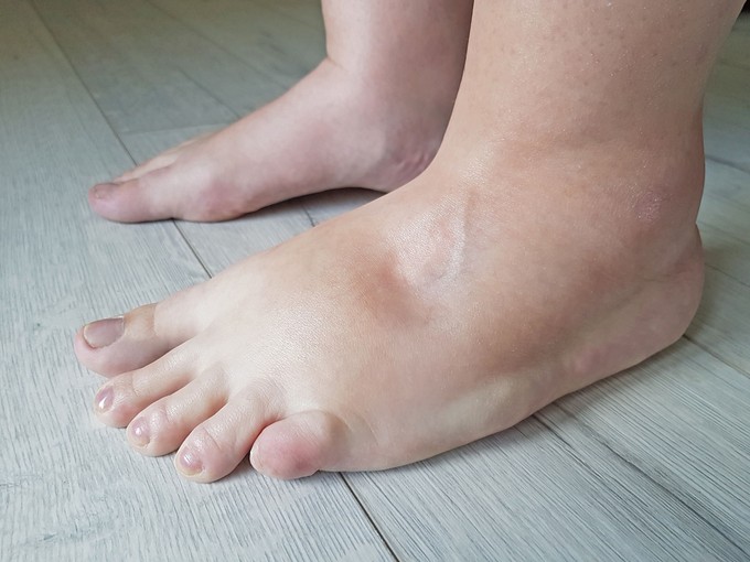 Nyomja meg pár másodpercre a bokáját: ha mélyedés marad utána, szívbetegség is állhat a háttérben című cikk nyitóképe