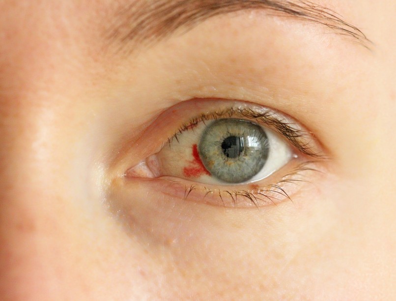 bevérzés trombózis vérrög tünet szem