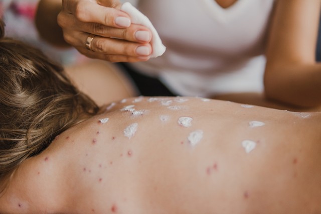 Bárányhimlős lett a védőoltást ellenző politikus