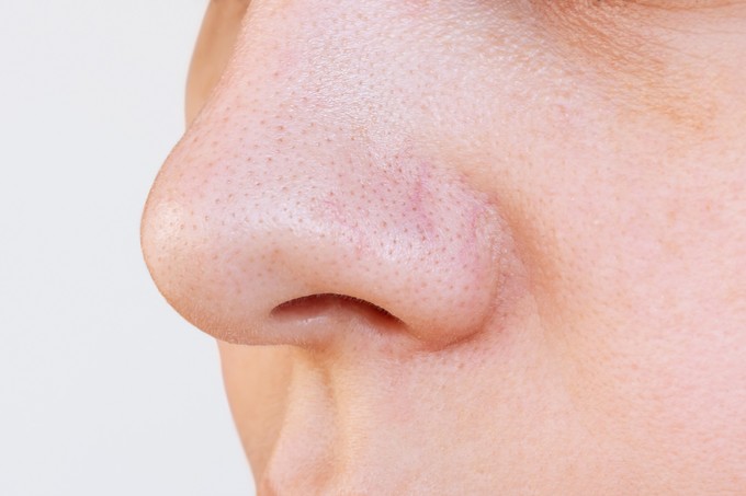 Fekete pöttyök az orron: így tüntetheti el a mitesszereket című cikk nyitóképe