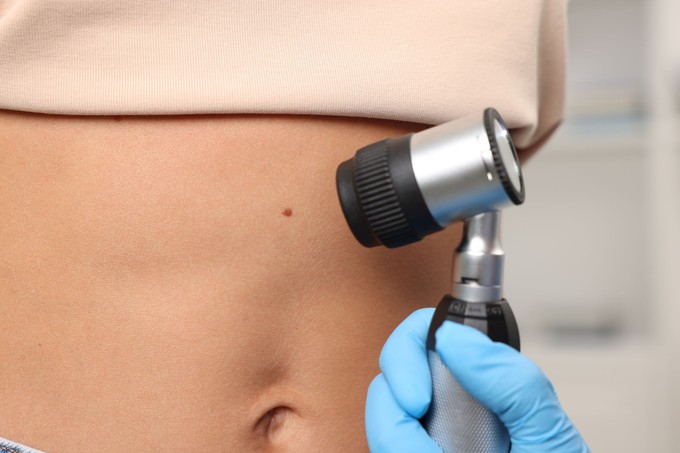 Veszélyes anyajegyek: 5 jel, ami miatt azonnal bőrgyógyászhoz kell fordulni című cikk nyitóképe