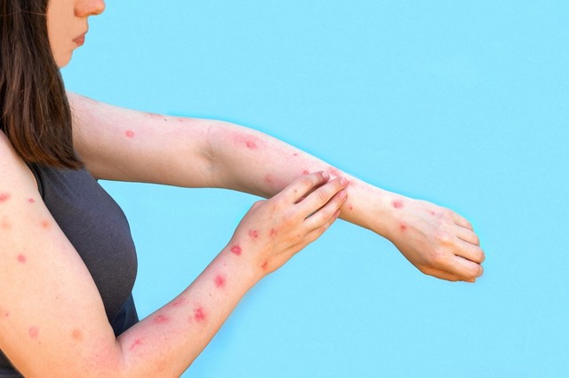 Majomhimlő: a spanyolokhoz már megérkezett az ellenszer