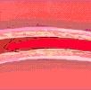 Atherosclerosis (érszűkület)