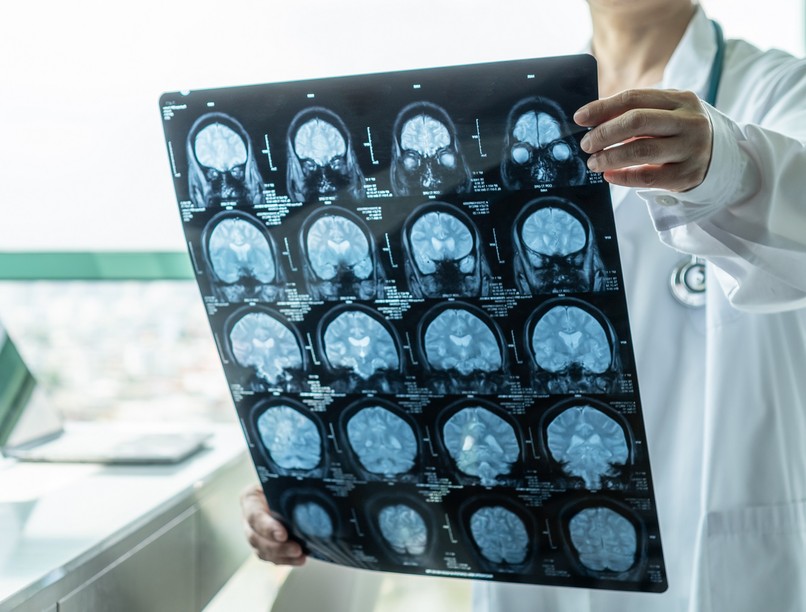 időskor élettartam demencia esélye