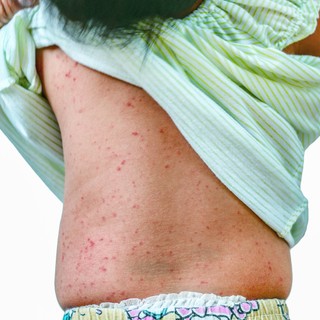 Rózsahimlő: így védekezhetünk ellene című cikk nyitóképe