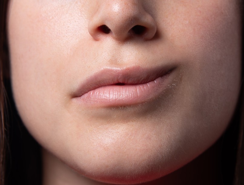 Bell-parézis arcideg-bénulás