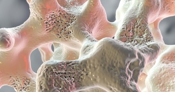  Ezek a csontritkulás első, korai tünetei - egyéb betegségek panaszaként is jelentkezhetnek 