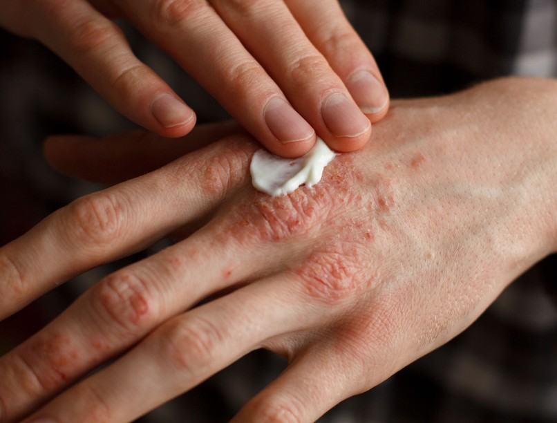ekcéma oka dermatitis atópiás ekcéma gyógynövények