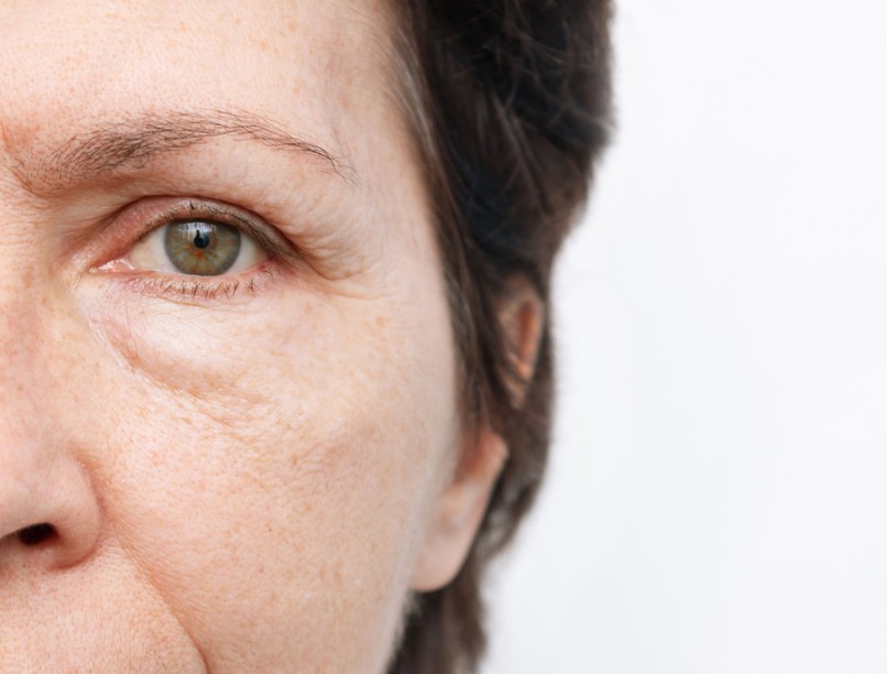 Felpüffedt arc betegség jele ödéma vese