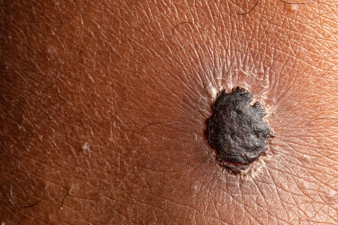 A melanóma első jelei: mit vegyen komolyan, és hogyan ismerheti fel időben a bőrrákot? című cikk nyitóképe